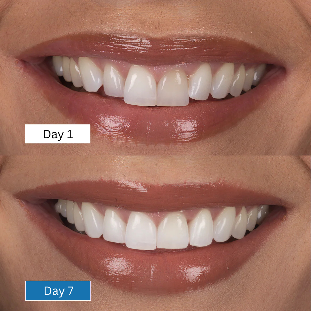 Get a Whiter Smile in Just 7 Days